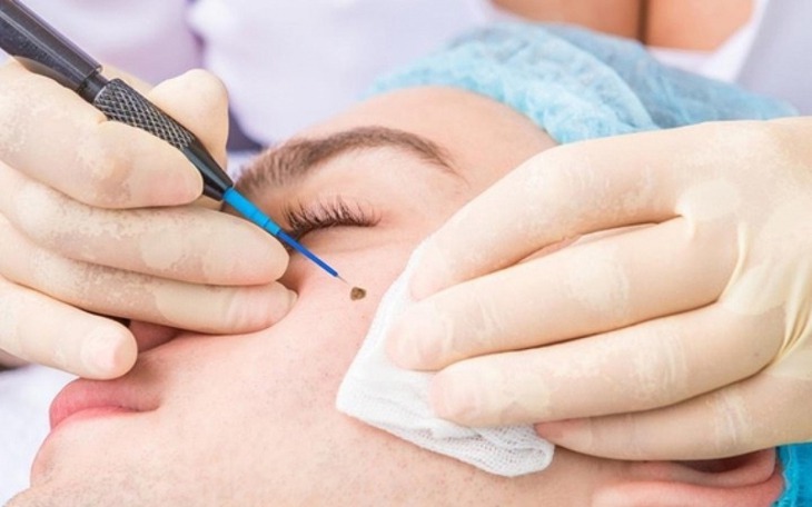 Đốt nốt ruồi nhiều lần, người đàn ông bất ngờ nhận tin dữ