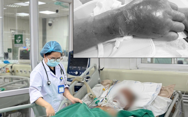 Bị tai nạn lao động nhưng không tiêm phòng uốn ván, bệnh nhân rơi vào nguy kịch