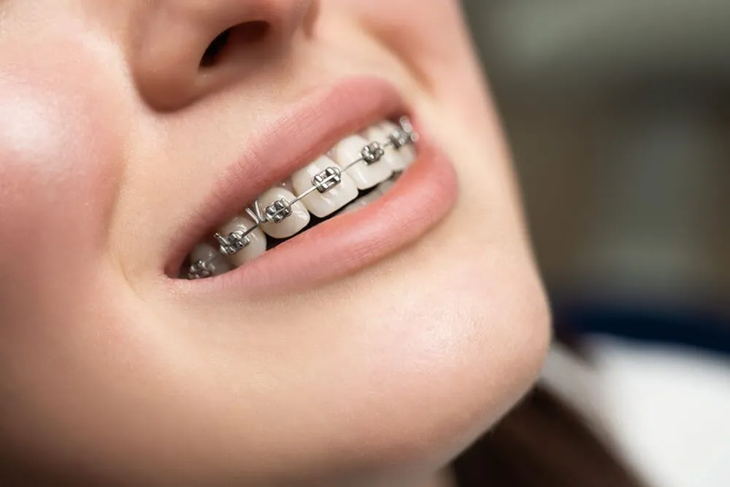 Vệ sinh răng nướu sau khi niềng răng: Bạn đã biết chưa?- Ảnh 1.