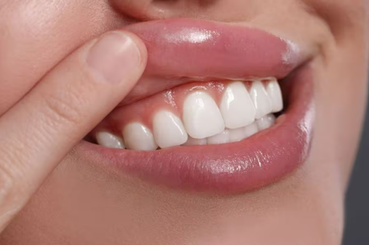 Bỏ quên khe nướu (lợi) - lý do đau răng, viêm nướu (lợi)  kéo dài- Ảnh 2.