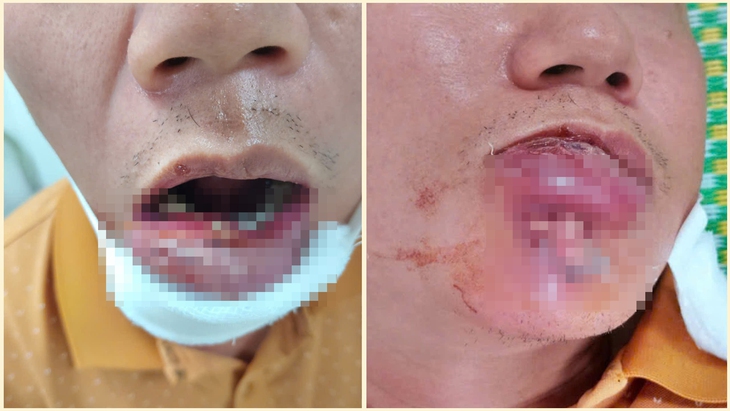 Tự điều trị mụn, nam bệnh nhân nhập viện vì áp xe sưng to vùng môi dưới- Ảnh 1.
