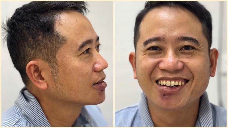 Tự điều trị mụn, nam bệnh nhân nhập viện vì áp xe sưng to vùng môi dưới- Ảnh 2.