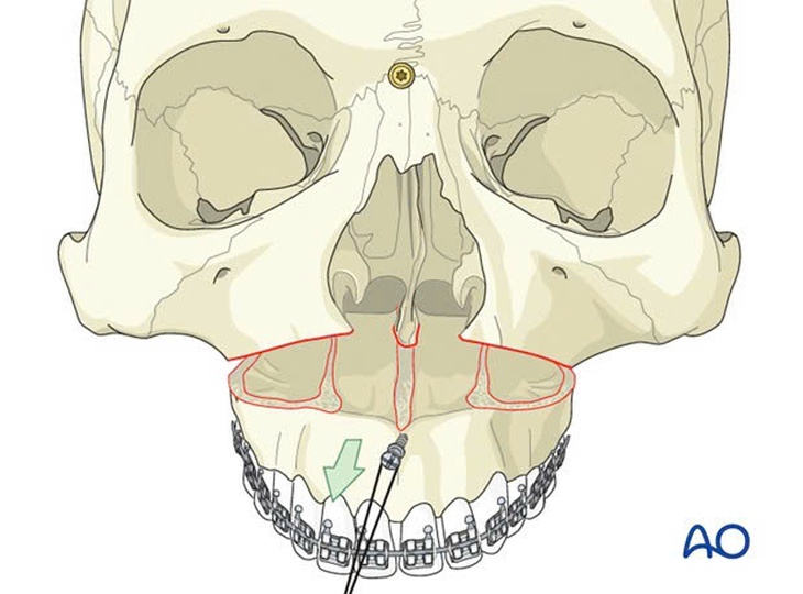 Điều trị móm (khớp cắn ngược) do xương hàm- Ảnh 4. Điều trị móm (khớp cắn ngược) do xương hàm- Ảnh 4.