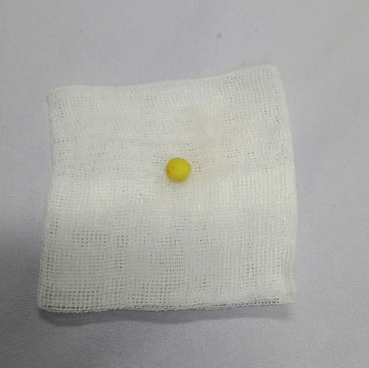 Cứu sống bệnh nhi 8 tuổi bị hóc dị vật đường thở- Ảnh 2.