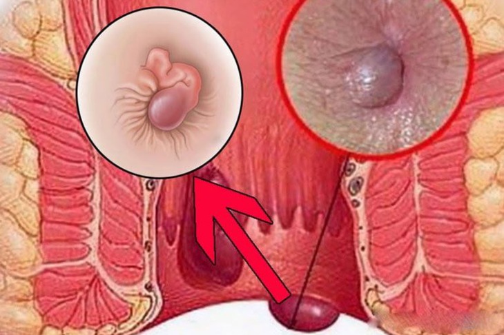 Cách phân biệt bệnh trĩ và những bệnh hậu môn để tránh nhầm lẫn- Ảnh 1.