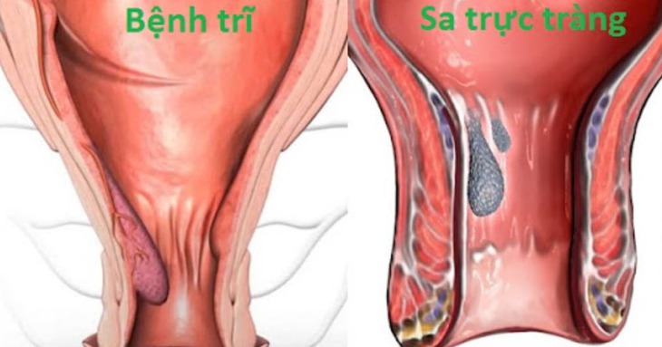 Cách phân biệt bệnh trĩ và những bệnh hậu môn để tránh nhầm lẫn- Ảnh 2.