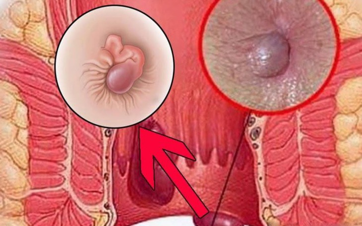 Diếp cá – vị thuốc dân gian hỗ trợ bệnh trĩ hiệu quả  - Ảnh 2.