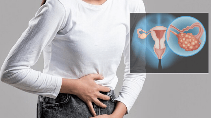 Có thể phát hiện sớm ung thư buồng trứng không?- Ảnh 1.