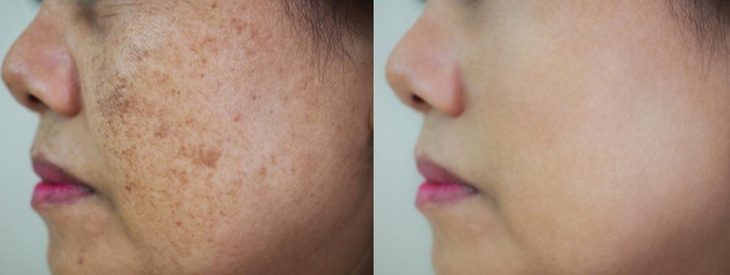 Các thuốc điều trị tăng sắc tố da sau viêm- Ảnh 1.