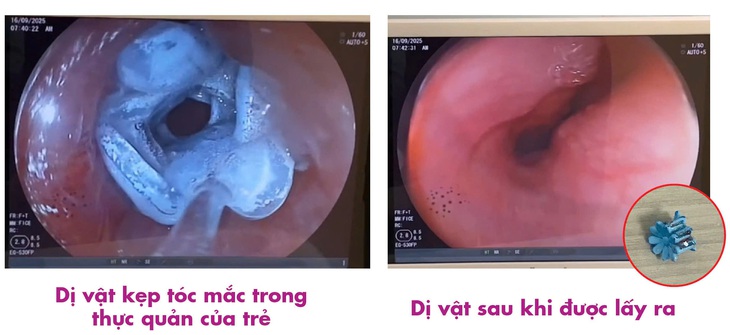 Cứu thành công bé 5 tuổi bị kẹt kẹp tóc trong thực quản- Ảnh 3.