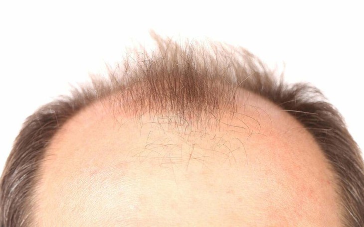 Đồ uống có đường - "thủ phạm" gây rụng tóc ở nam giới