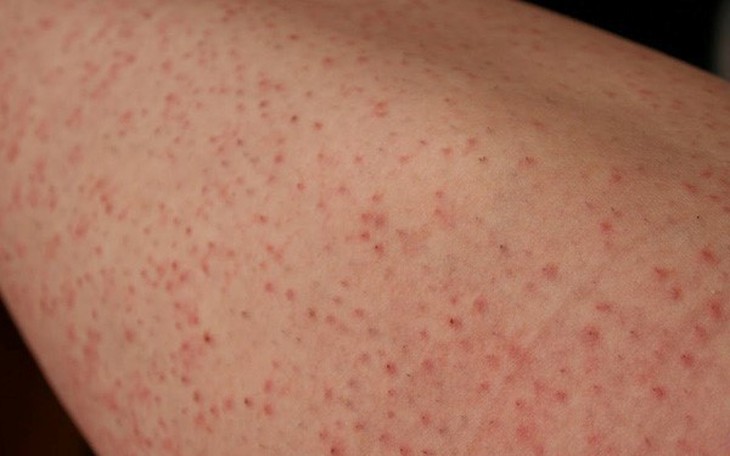 Điều trị triệt để ung thư nang lông giúp giảm tái phát- Ảnh 3.