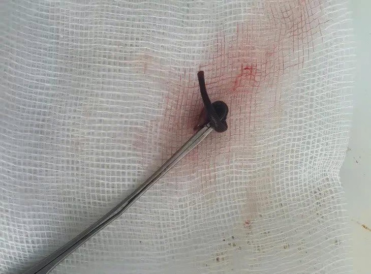Phát hiện con vắt dài 3cm sống trong mũi cô gái hơn 1 tuần- Ảnh 1.