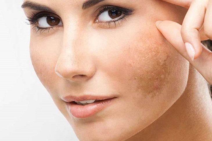 Uống gì để đẹp da, giảm nám cho phụ nữ sau tuổi 30?- Ảnh 1.
