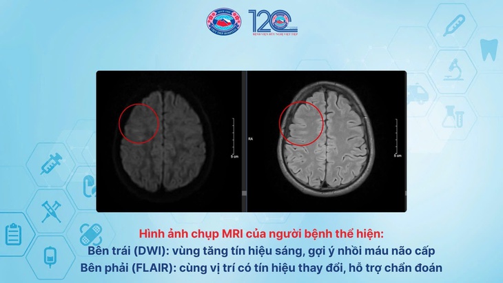 Cứu sống bệnh nhân 41 tuổi bị đột quỵ não, suýt tàn phế vĩnh viễn- Ảnh 2. Cứu sống bệnh nhân 41 tuổi bị đột quỵ não, suýt tàn phế vĩnh viễn- Ảnh 2.