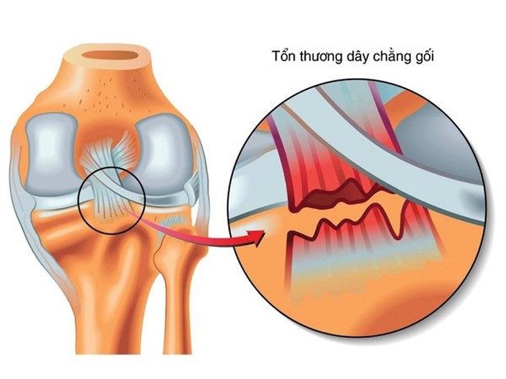ĐỨT DÂY CHẰNG BÊN TRONG GỐI: NGUYÊN NHÂN, TRIỆU CHỨNG VÀ CÁCH ĐIỀU TRỊ HIỆU QUẢ