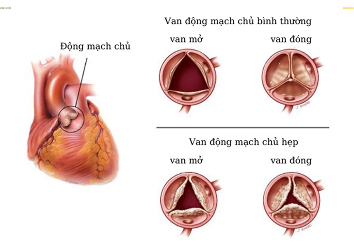 Biến chứng nguy hiểm hẹp van động mạch chủ và cách điều trị- Ảnh 1.