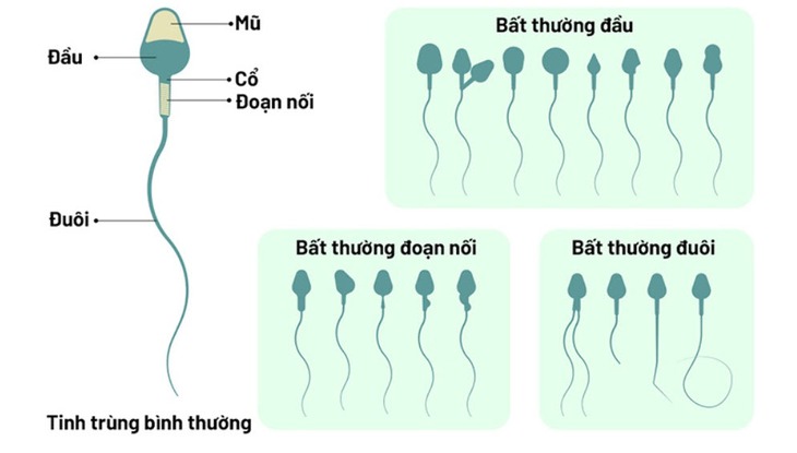 Đột biến CFAP65 khiến tinh trùng bất động - Ảnh 1.