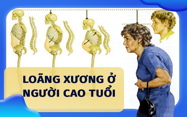 Loãng xương ở người cao tuổi dùng thuốc và chữa như thế nào?- Ảnh 1.