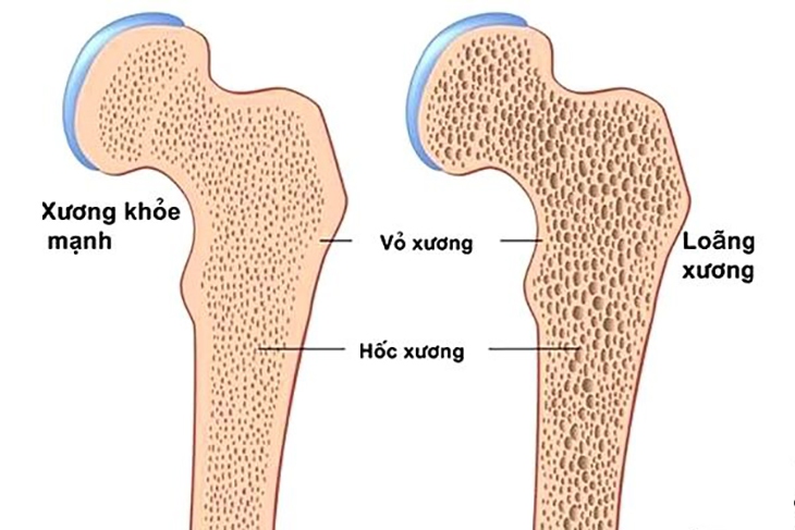 Tại sao người nhiễm HIV dễ bị loãng xương?- Ảnh 1.