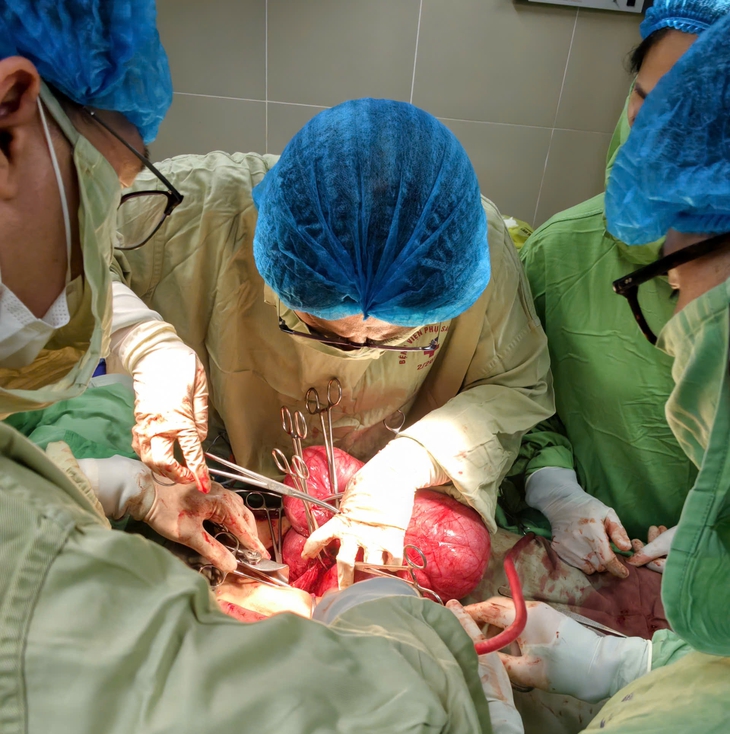 Phẫu thuật lấy khối u xơ tử cung nặng 3,2kg cho người phụ nữ ở Hà Nội- Ảnh 1.
