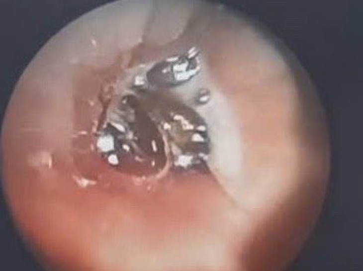 Bất ngờ phát hiện hạt hồng xiêm bị 'bỏ quên' hơn 10 năm trong phế quản- Ảnh 1. Bất ngờ phát hiện hạt hồng xiêm bị 'bỏ quên' hơn 10 năm trong phế quản- Ảnh 1.