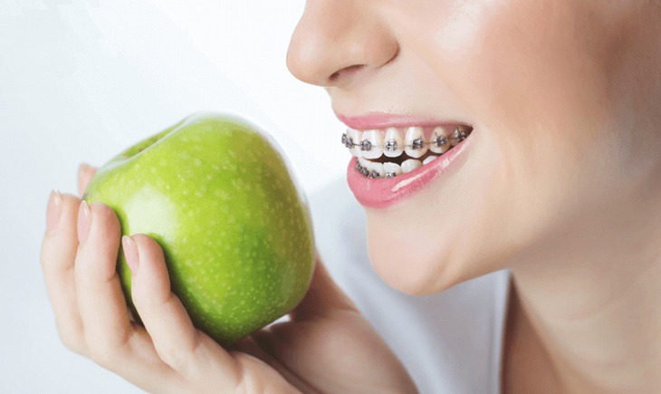 5 loại thực phẩm nên kiêng khi niềng răng- Ảnh 2.