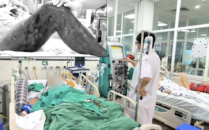 Bà đắp thuốc nam cho cháu bị mèo cắn, cả bàn chân hoại tử- Ảnh 1.