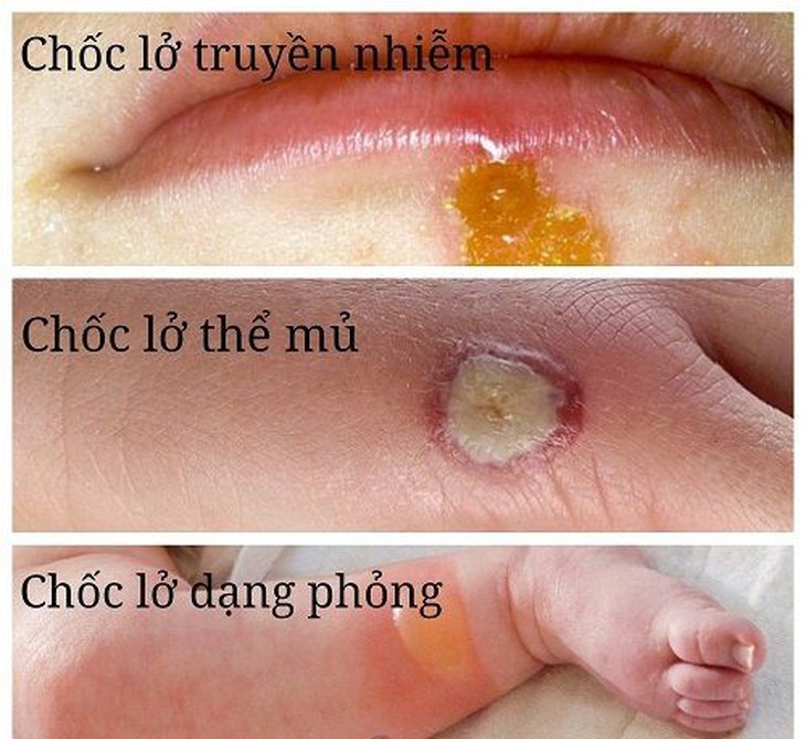 Bệnh chốc lở - Dùng thuốc nào để điều trị?- Ảnh 1.