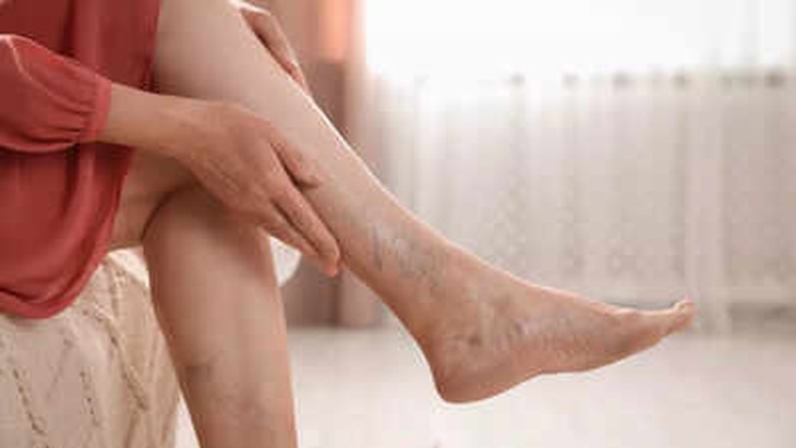Giãn tĩnh mạch - Dấu hiệu âm thầm và cách phòng ngừa tự nhiên- Ảnh 1.