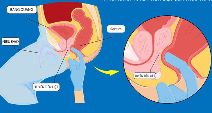 4 biểu hiện của phì đại tuyến tiền liệt nam giới cần biết- Ảnh 1.