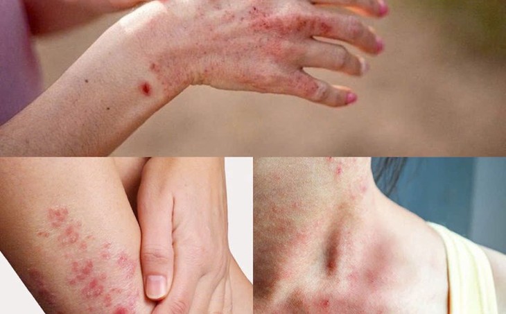 Thuốc điều trị viêm da trong mùa mưa- Ảnh 1.