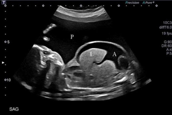 Thai nhi bị thiếu máu: Nguy cơ tử vong và giải pháp đột phá từ y học bào thai- Ảnh 1.