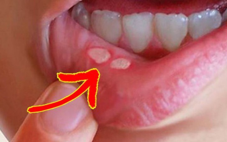 HIV ảnh hưởng đến sức khỏe răng miệng như thế nào?
