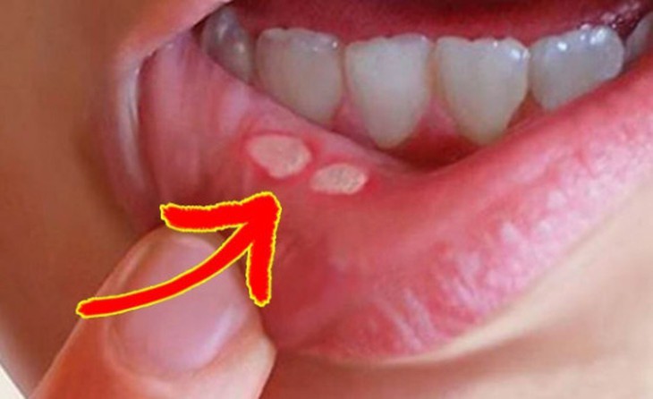 HIV ảnh hưởng đến sức khỏe răng miệng như thế nào?- Ảnh 1.