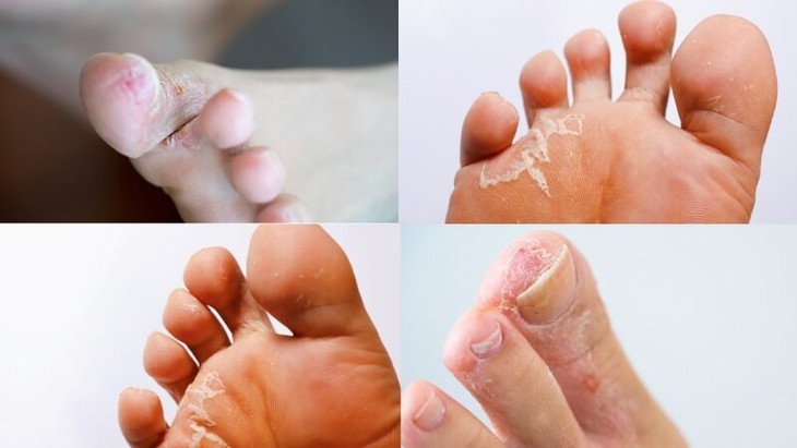 Nước ăn chân - Dùng thuốc và các phương pháp chữa trị tại nhà- Ảnh 1.