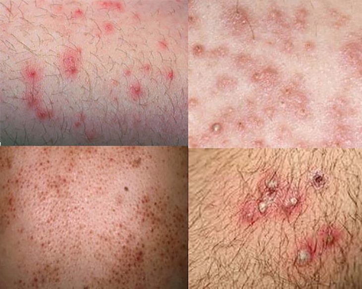 Điều trị viêm nang lông bằng thuốc - Khi nào cần sử dụng?- Ảnh 1. Điều trị viêm nang lông bằng thuốc - Khi nào cần sử dụng?- Ảnh 1.