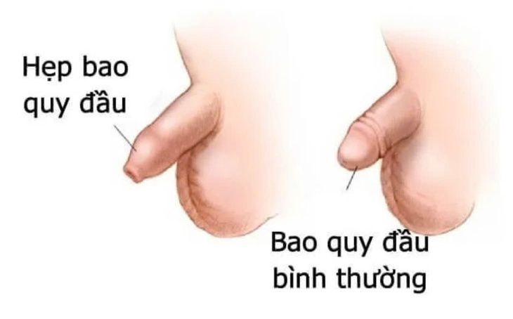 Nam giới bị hẹp bao quy đầu có quan hệ được không?- Ảnh 2.