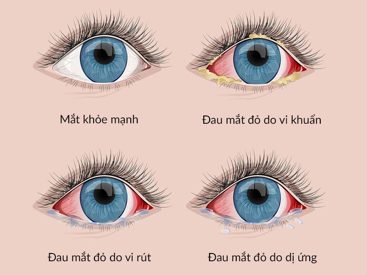 Đau mắt đỏ - Thuốc trị theo nguyên nhân và những biện pháp hỗ trợ không dùng thuốc- Ảnh 1.