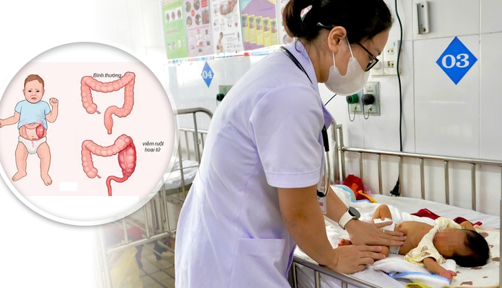 Cứu sống trẻ sinh non bị viêm ruột hoại tử
- Ảnh 1.