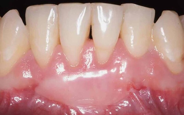 Những điều nên và không nên sau ghép lợi- Ảnh 1.
