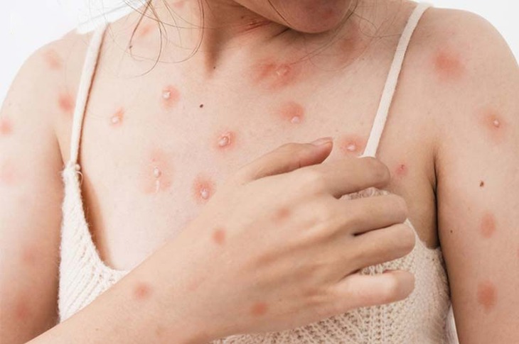 Cảnh báo thủy đậu ở người lớn có thể gây biến chứng nguy hiểm- Ảnh 1. Cảnh báo thủy đậu ở người lớn có thể gây biến chứng nguy hiểm- Ảnh 1.