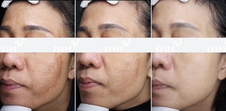 Không cần thực hiện xâm lấn, Dr.Huy Clinic làm chủ xu hướng trẻ da an toàn- Ảnh 2.