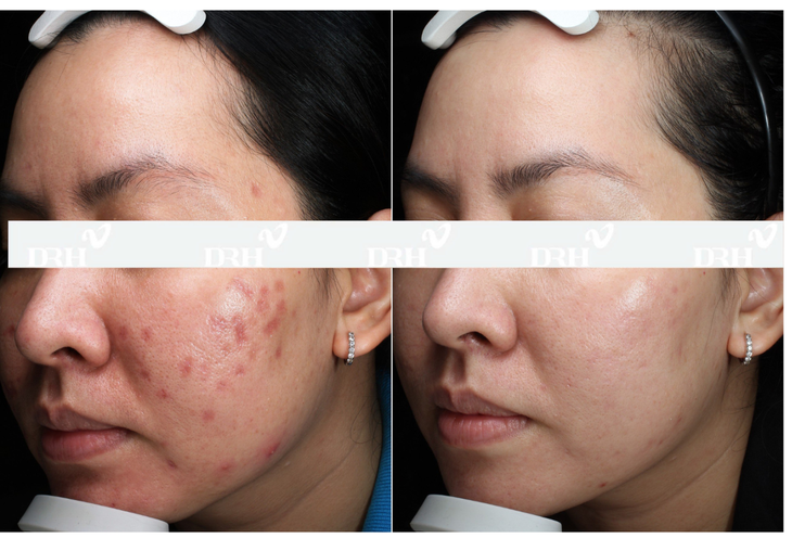 Không cần thực hiện xâm lấn, Dr.Huy Clinic làm chủ xu hướng trẻ da an toàn- Ảnh 1.