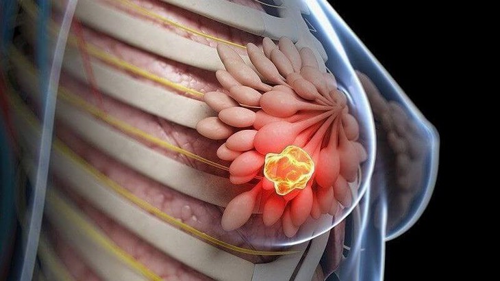 Thời điểm phụ nữ nên đi khám tầm soát ung thư vú- Ảnh 1.