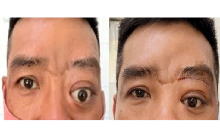 Bệnh hiếm gây lồi mắt, 20 năm Bệnh viện Tai Mũi Họng TPHCM chỉ gặp 2 ca