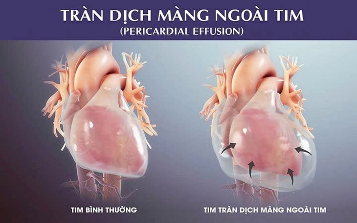 Cấp cứu bệnh nhi bị tràn dịch màng ngoài tim nguy kịch- Ảnh 1. Cấp cứu bệnh nhi bị tràn dịch màng ngoài tim nguy kịch- Ảnh 1.