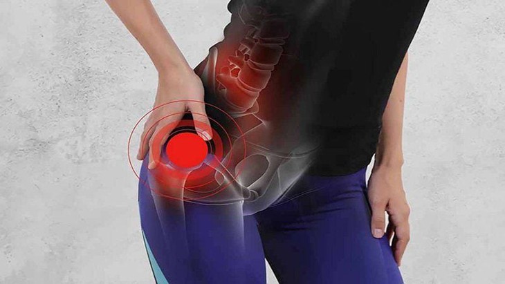 Đau khớp háng, dấu hiệu của nhiều bệnh lý- Ảnh 1. Đau khớp háng, dấu hiệu của nhiều bệnh lý- Ảnh 1.