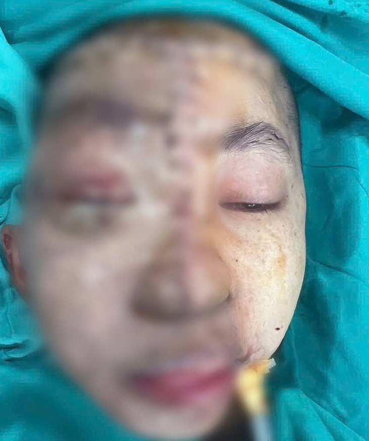 Cô gái 19 tuổi được phẫu thuật sau 17 năm mang khối u khổng lồ vùng mặt- Ảnh 2. Cô gái 19 tuổi được phẫu thuật sau 17 năm mang khối u khổng lồ vùng mặt- Ảnh 2.
