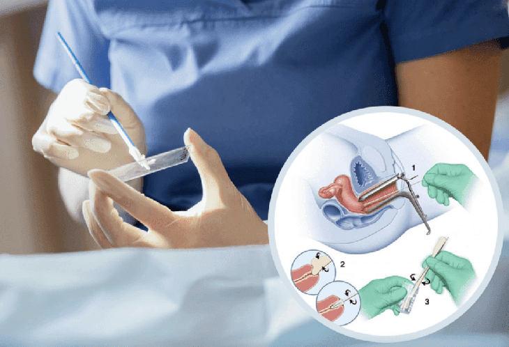 Khi nào nên làm xét nghiệm Pap để sàng lọc ung thư cổ tử cung?- Ảnh 1.